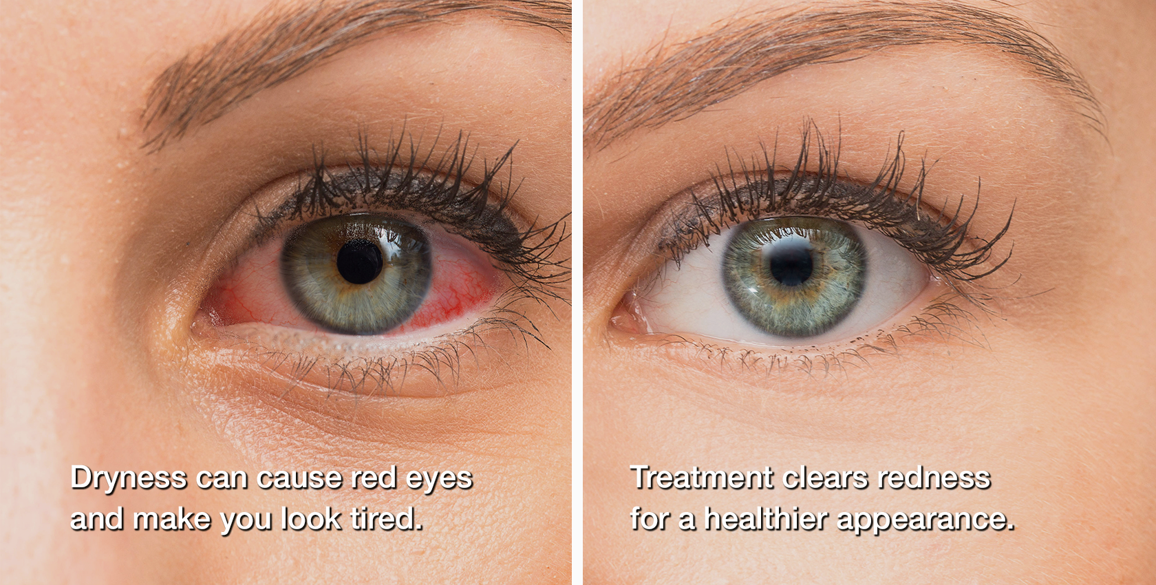 before and after dry eye treatment