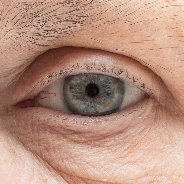 after cataract surgery